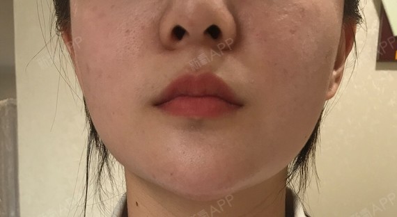 这是第二天,咬肌比较大的那一边肿的比较明显,但是不_圈子-新氧美容