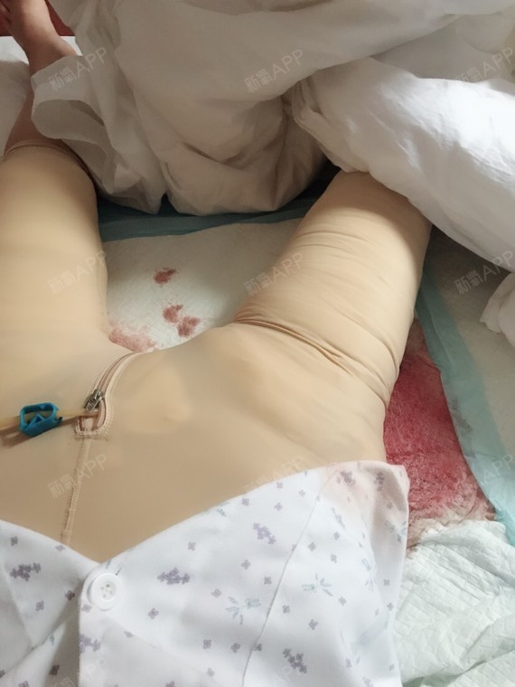 吸脂瘦大腿好不好_效果图_氧气qm5b793吸脂瘦大腿术后第0天_新氧美容