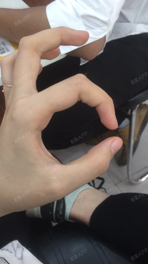 大腿内侧的青紫在一点点的消除,坐久了,起来还是会疼_圈子-新氧美容
