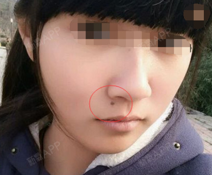 嘴上长了个大痣,家里人说是贪吃痣,小时候家人为了安_圈子-新氧美容