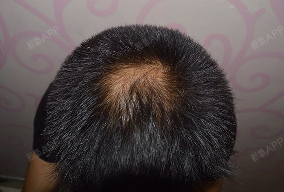 头顶发旋脱发,发际线也微调规整下.