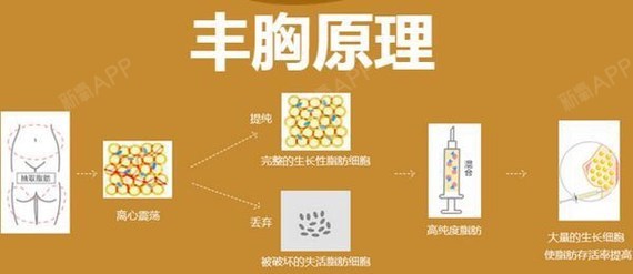 科普自体脂肪隆胸手术安全性主要体现在以下几