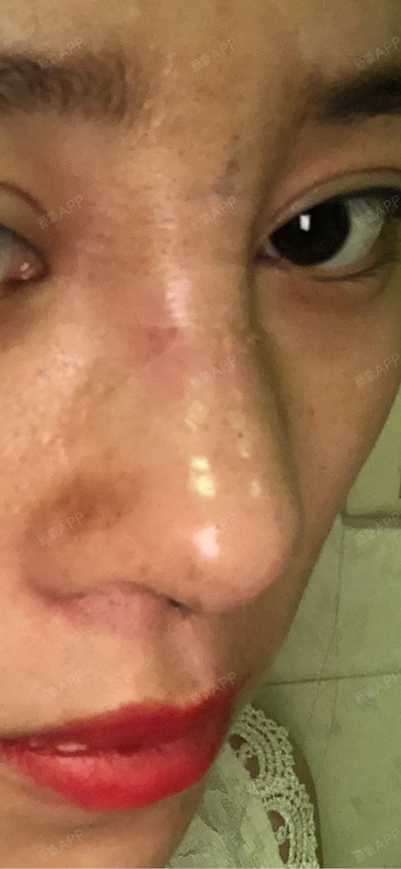 半肋软骨隆鼻第七天鼻背宽的难看死了,鼻背不平整凹凸_圈子-新氧美容