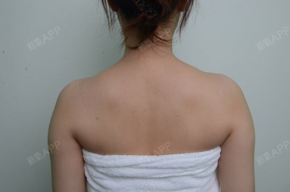 今天第一天来尝试肉毒素瘦肩肌,一共两只,一共200_圈子-新氧美容整形