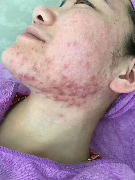 新氧- 心软却想酷珴鈈渼柦綪深 | 皮肤 | 术后当自强 | 天津同城