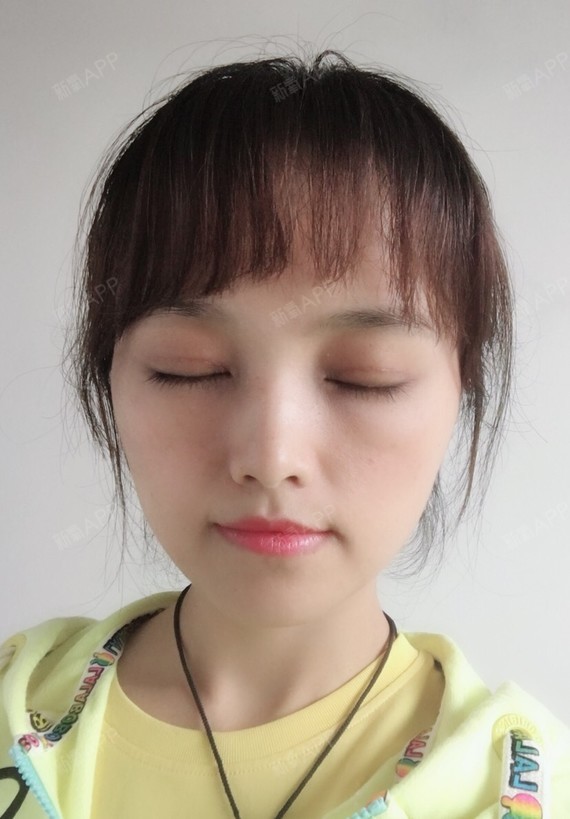 切开双眼皮