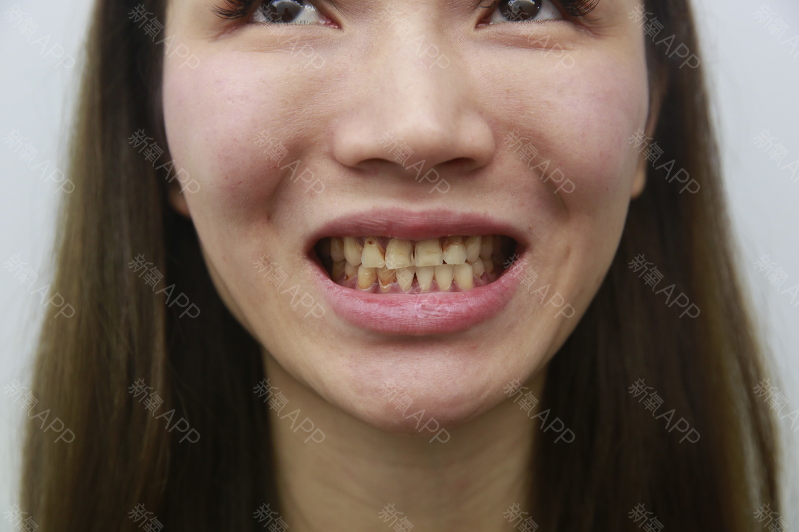 石家庄美莱医学美容医院瓷贴面怎么样_恢复过程_效果如何_小雯文整形