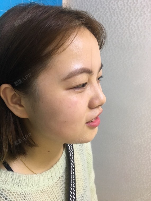 术前侧脸四十五度非常明显的咬肌发达[:137]今天_圈子-新氧美容整形