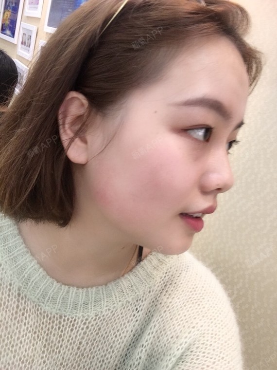 术前侧脸四十五度