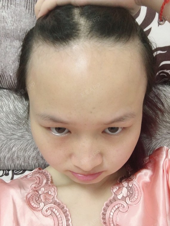 真的很希望能抽中我,改变祖传的宽大额头,我爸以前也_圈子-新氧美容