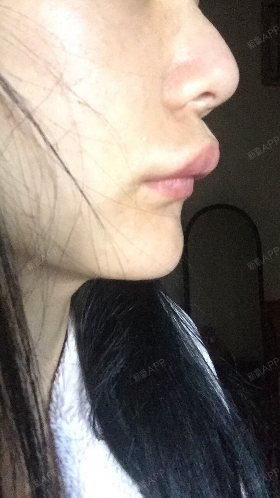 氧气7dy9764假体垫鼻基底术后第4天美丽日记_新氧整形