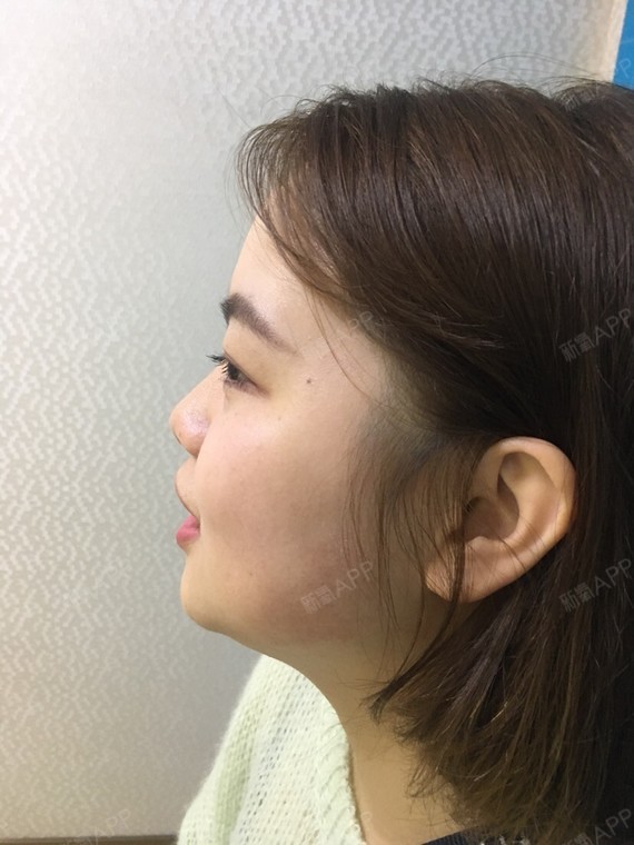 术前侧脸四十五度