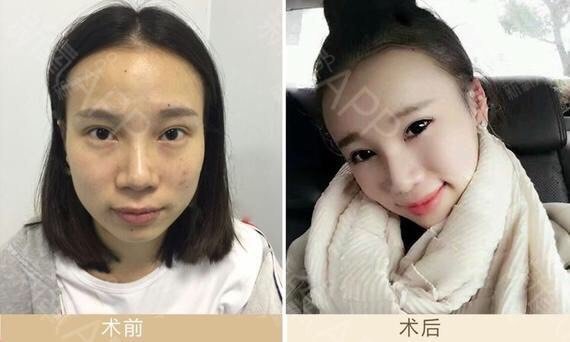 面部脂肪填充術後對比,輕鬆還你童顏,少女感十足