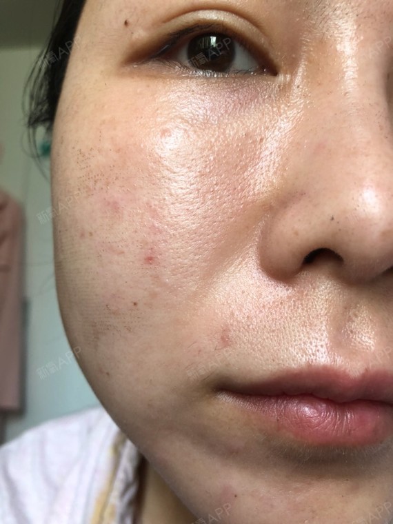 痂掉了很多,第四天通过新氧消费方案查看点阵激光光电中度疼痛祛痘坑