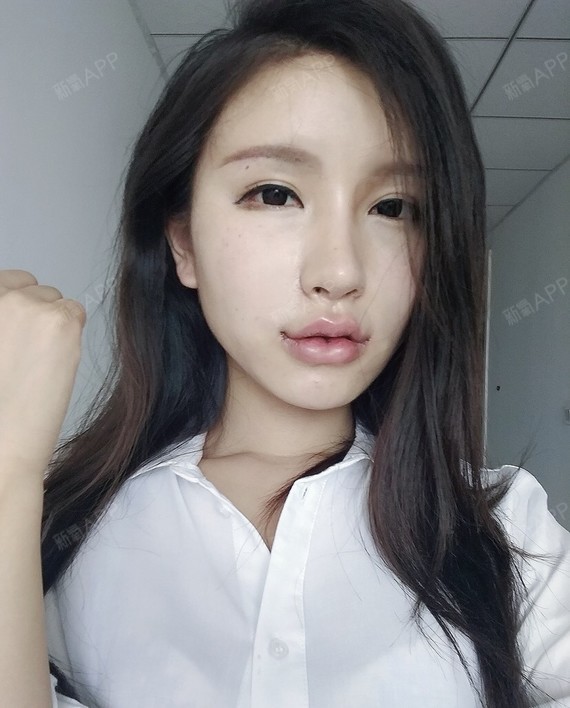 74上唇m唇 下唇嘟嘟唇 嘴角上扬74术后第2天74成都_圈子-新氧