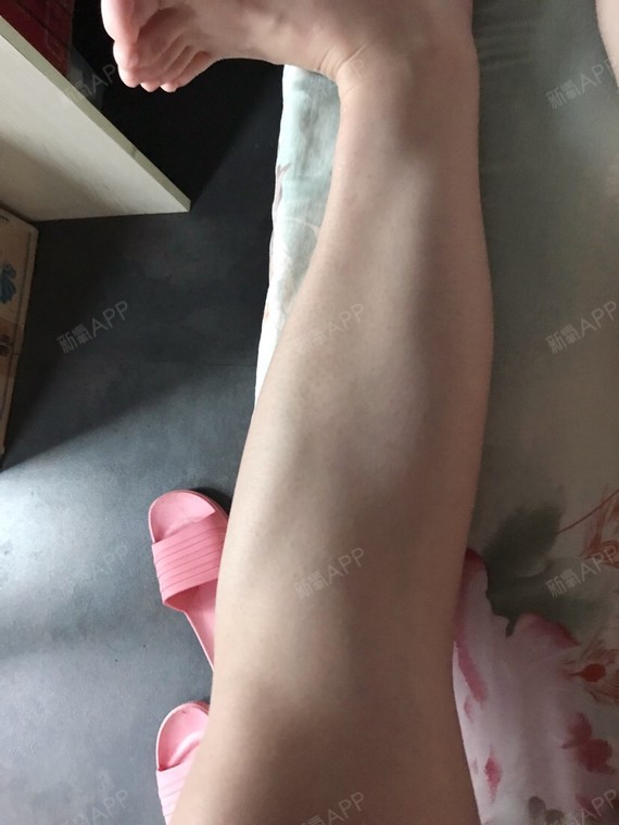 大路aiym肉毒素瘦小腿第14天美丽日记