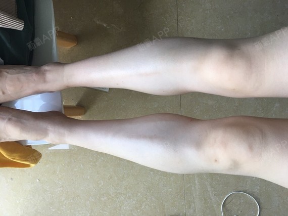 今天打瘦腿针第12天了.