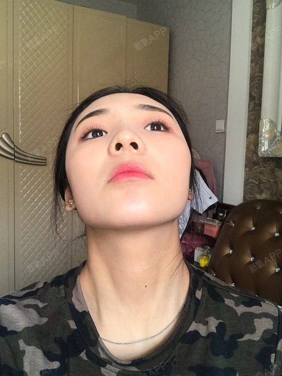 脸上都没有动过不过脸歪是什么情况颧骨高低都不一样要_圈子-新氧美容