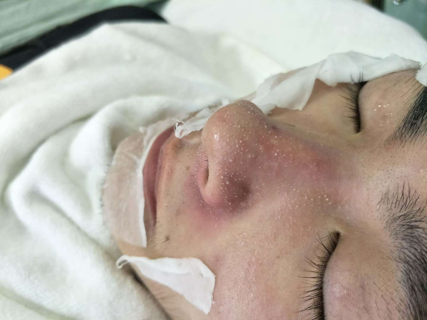 韩尚美(南昌店)超微小气泡怎么样_恢复过程_效果如何_李二号整形日记