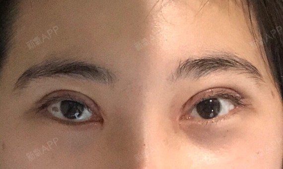 对称一点了!hhhhh 但是右眼内眼角增生有点厉害的 好痒 坚持贴美皮护