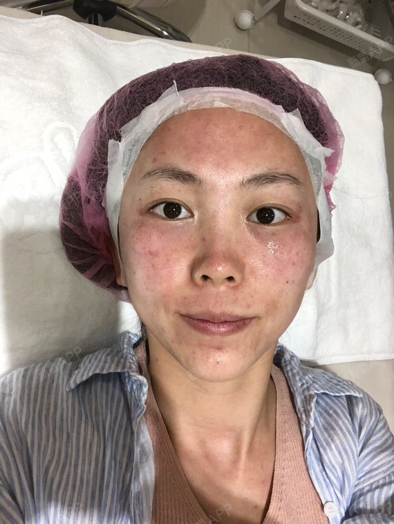 holly0皮秒激光第0天美丽日记