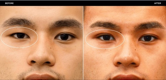 双眼皮】分享一例男士单侧双眼皮术后1个月效果