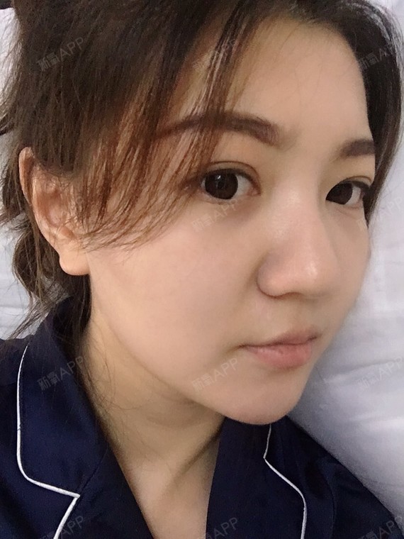 打完瘦脸针已经20天了,感觉效果特别好.虽然我的脸_圈子-新氧美容整形
