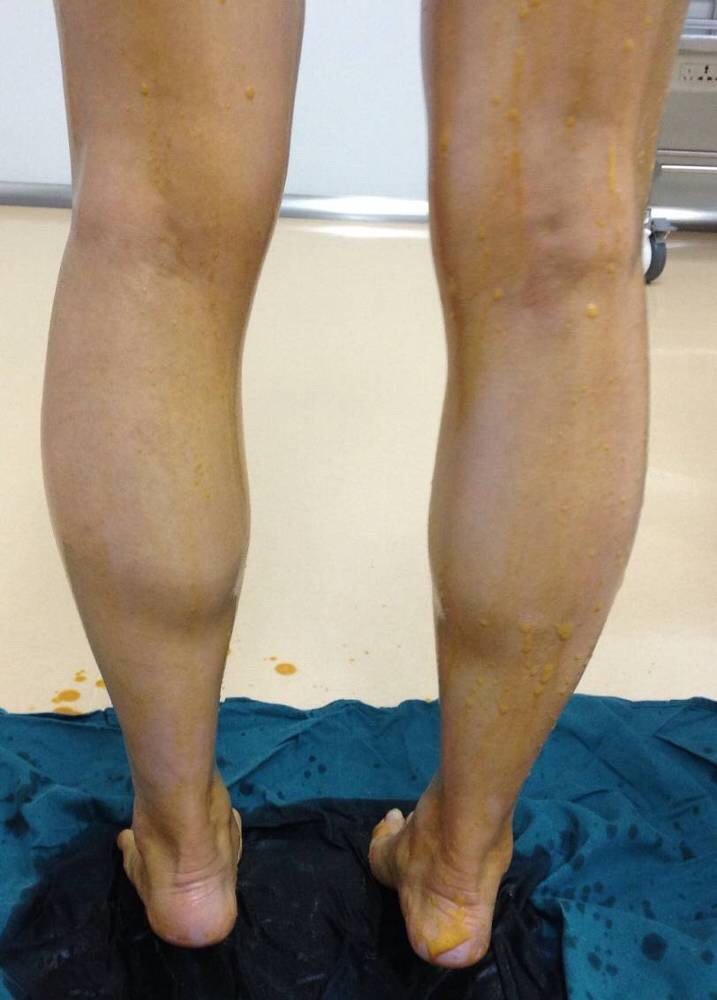 小腿神经阻断术第0天