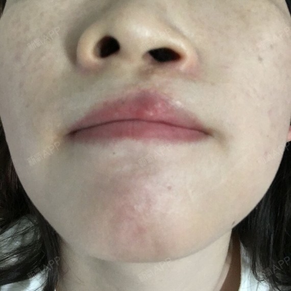 我的鼻小柱歪的鼻梁很塌嘴唇是兔唇想矫正鼻_圈子-新氧美容整形