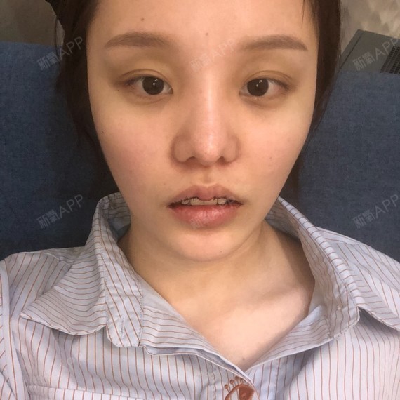 厚唇改薄