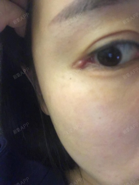 新氧- 氧气5720f2cc62a2193 | 眼部 | 开眼角 | 开外眼角 | 自体脂肪