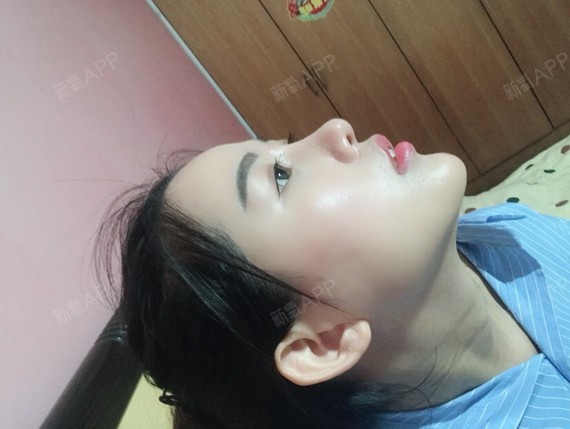 长沙手术延长鼻小柱好不好_效果图_大脸猫_126668手术延长鼻小柱术后