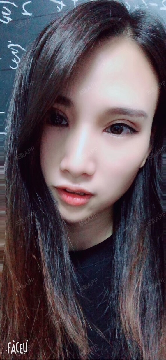 但每天都有明显的改善,特别是拆线以后,眼皮瞬间舒服多了,恢复也特别