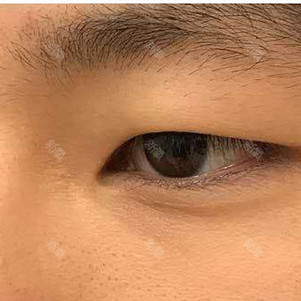 合肥上眼睑去脂好不好_效果图_路人甲cc上眼睑去脂术后第31天_新氧