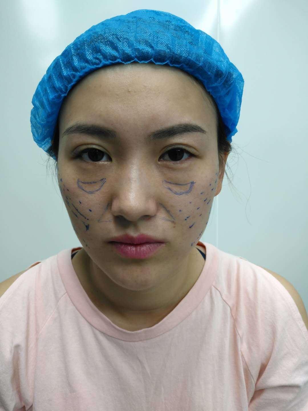 真人案例：面部埋线+乳腺修复术-蜜颜优惠
