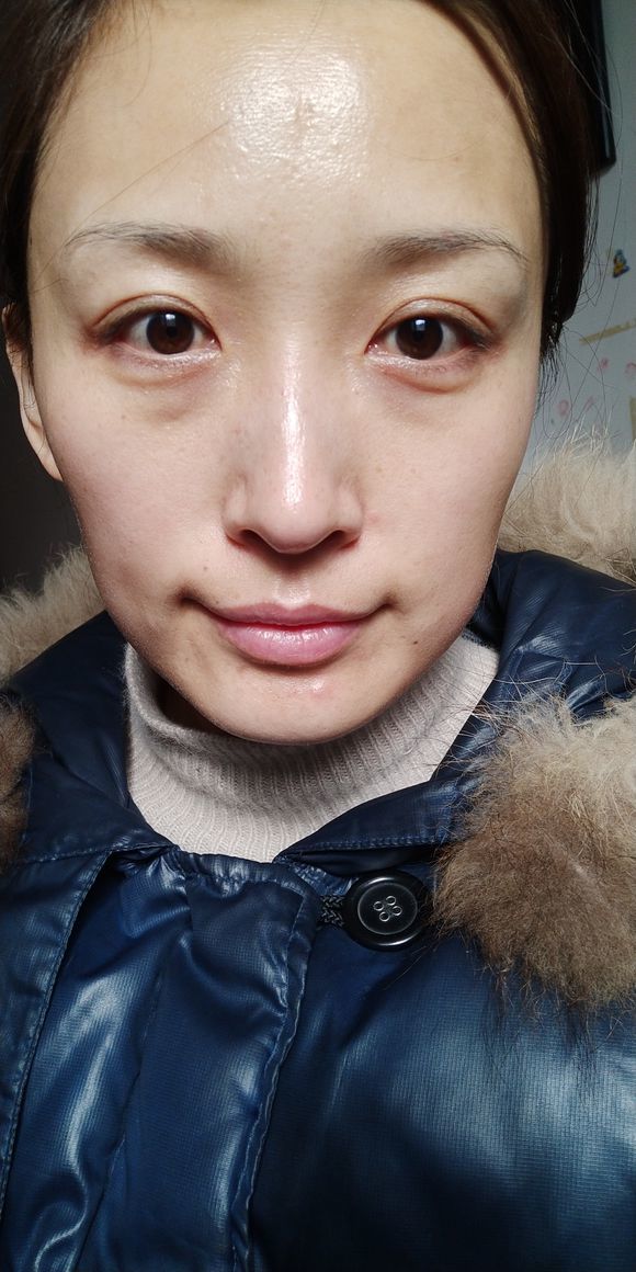 杭州艾尔莎61奥拉克医疗美容外切去眼袋怎么样_恢复过程_效果如何