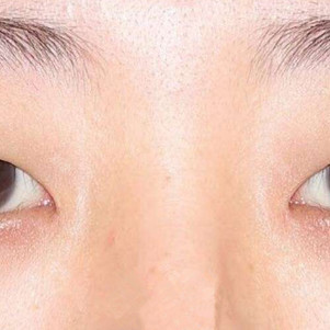 纳米双眼皮77内外眼角:我的眼睛是很短,有时候看自己_圈子-新氧美容