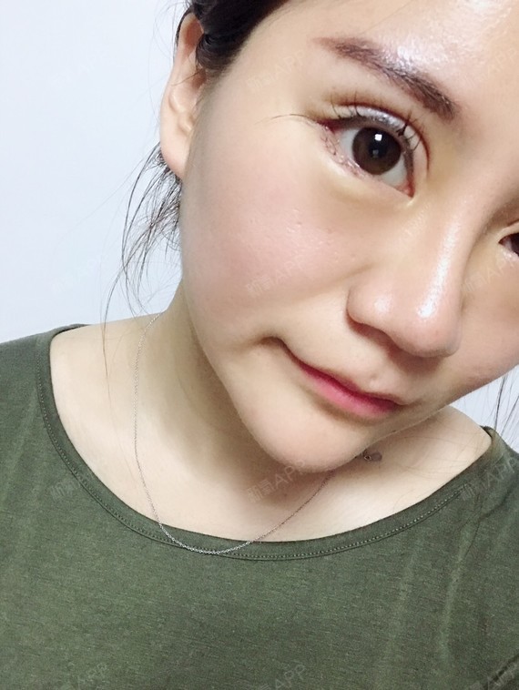 沈阳开外眼角好不好_效果图_熊宝宝baby开外眼角术后第4天_新氧美容