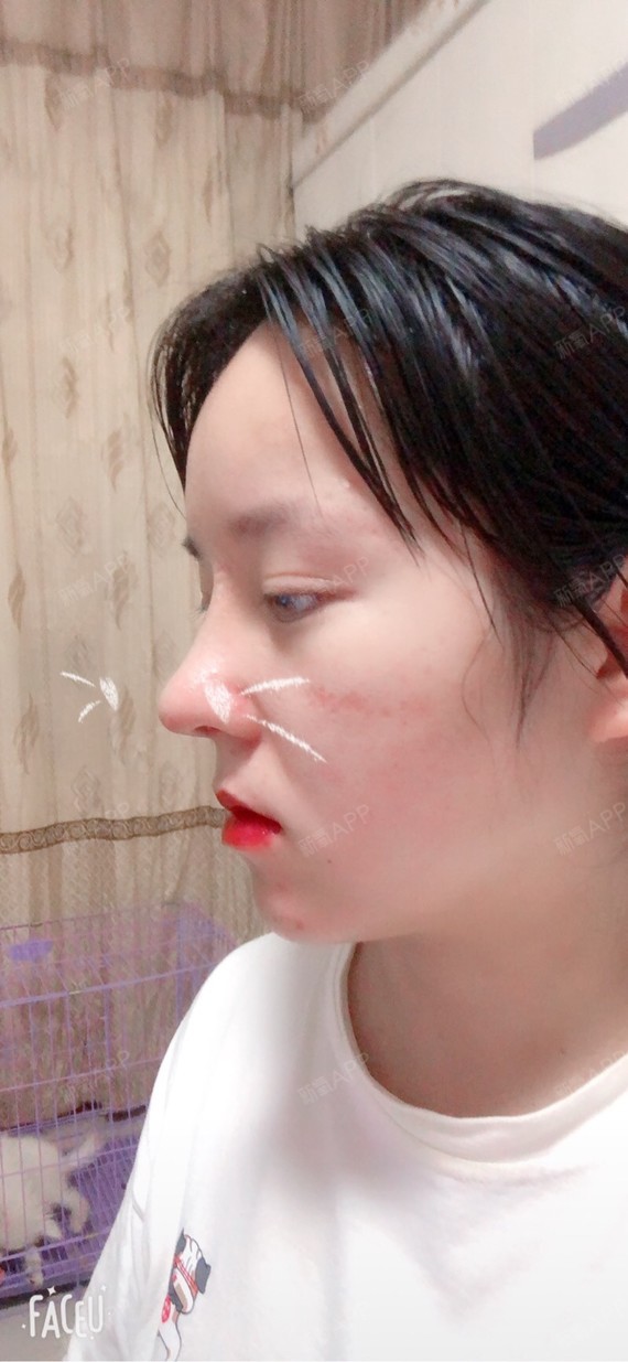 肋软骨隆鼻