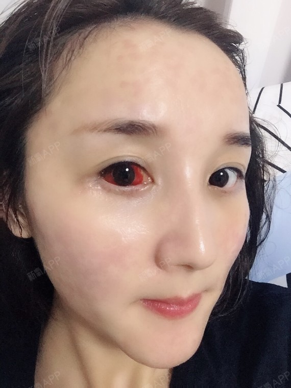 今天是手术后的第九天,也是拆线后的第二天,终于可以_圈子-新氧美容