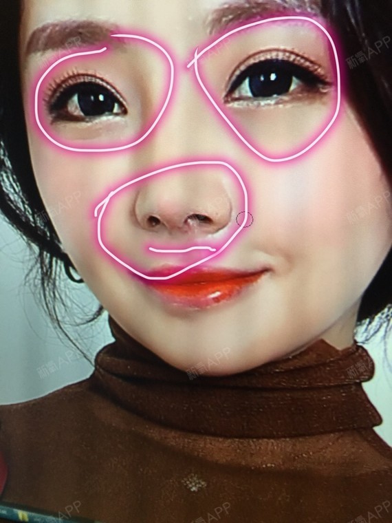 北京硅胶隆鼻好不好_效果图_灵儿要做大美女硅胶隆鼻术后第15天_新氧