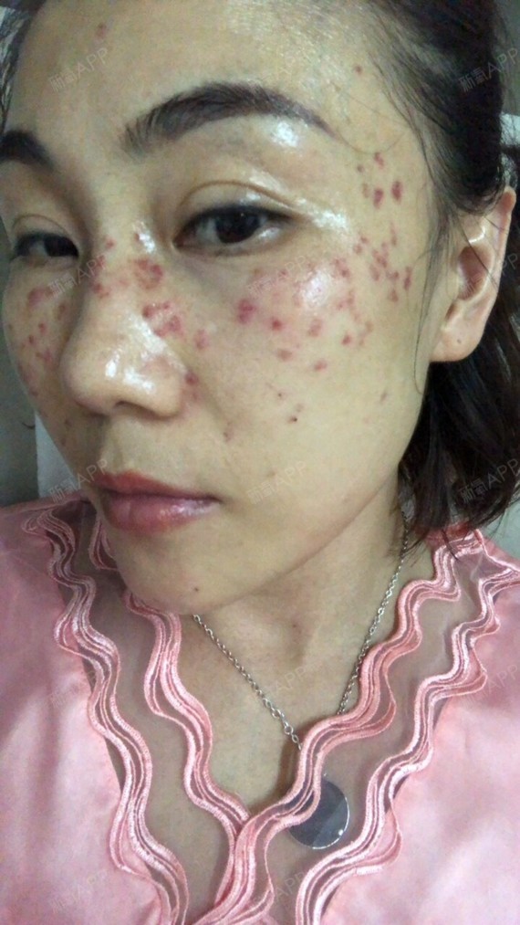 刚刚做完的样子做完第二天冰敷的效果通过新氧消费方案查看激光祛斑