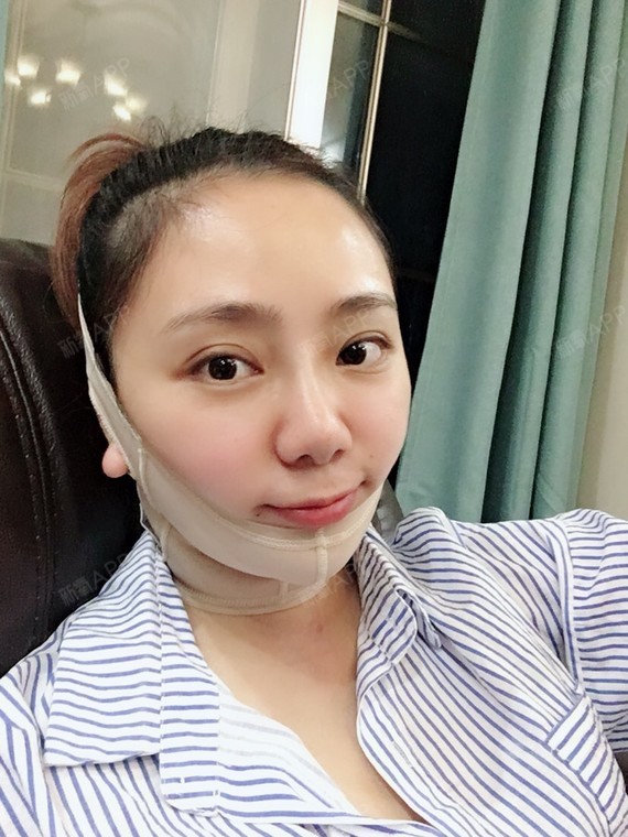 吸脂颈部下颌缘第5天,宝宝们,从下面照片看我已经换了一个头套了,这个