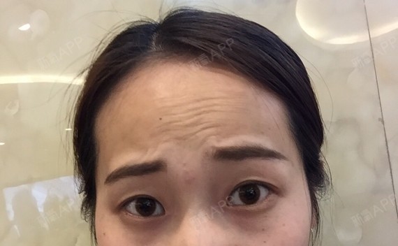 从我上高中开始就慢慢发现自己眼角和额头有些小细纹了_圈子-新氧美容