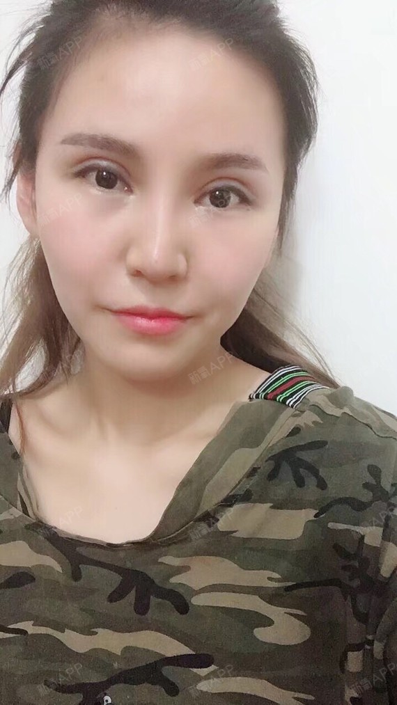 这是第7天,已经能明显看到凹陷的很明显了