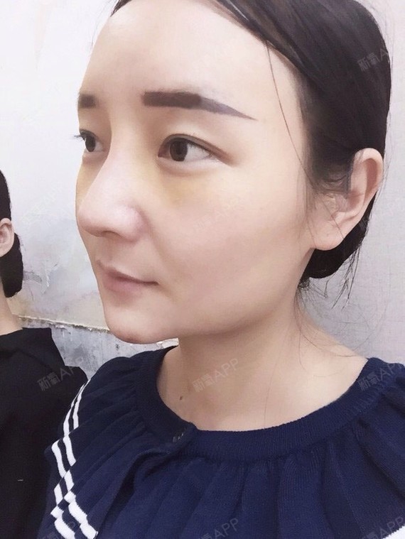 我的鼻子山根低,显得眼距宽眼睛_圈子-新氧美容整形