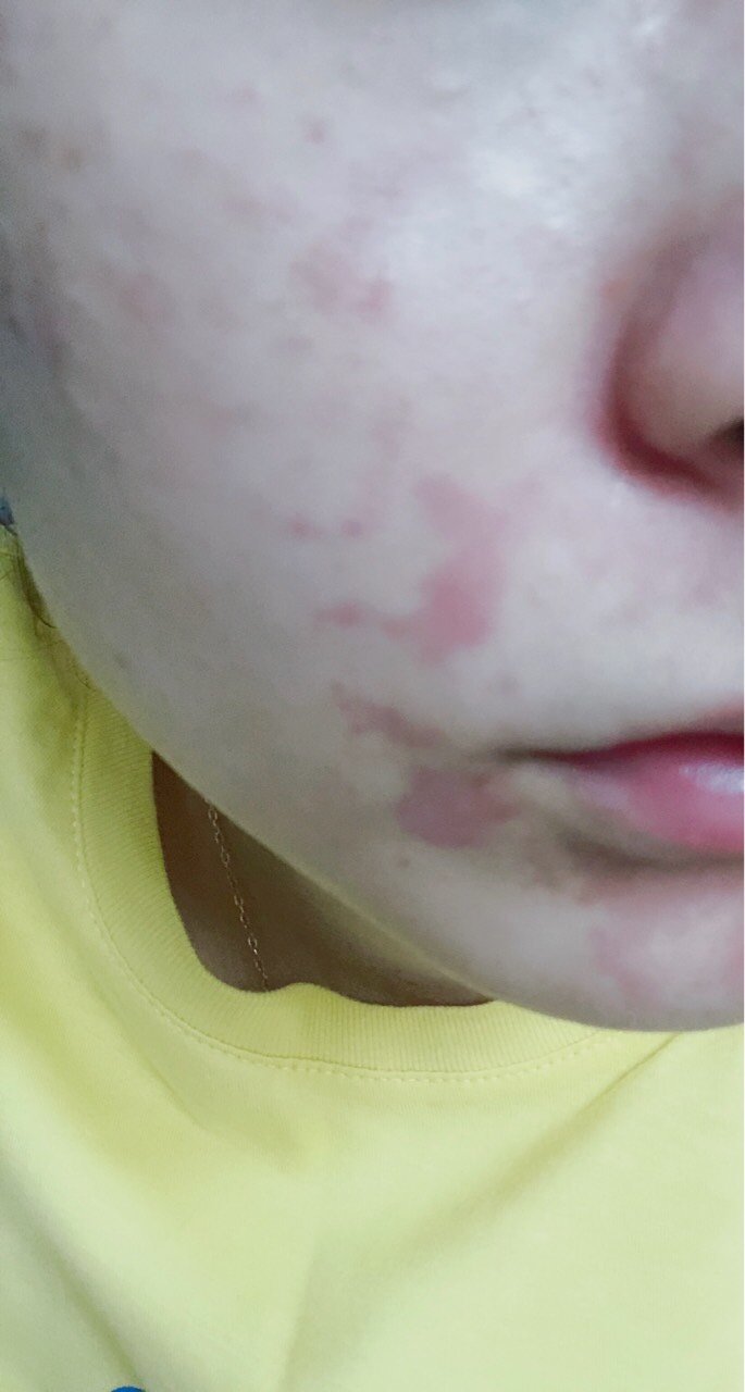 第三张是做完之后 局部脸的凸起.我体质对麻药有点过敏 脸非常红 .