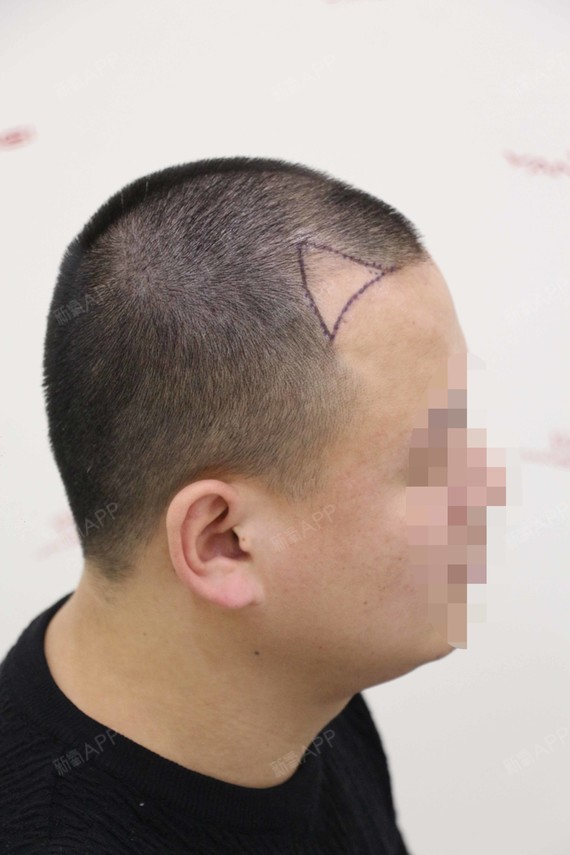 额角加密发际线种植201天,有没有觉得我的头发长的_圈子-新氧美容整形