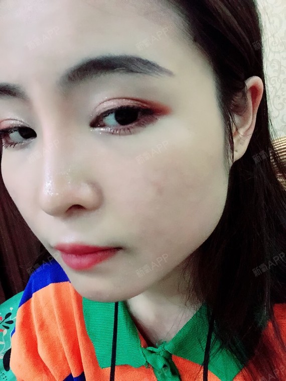 今天是打完瘦脸针的第六天,感觉咬肌还是有点酸胀,吃_圈子-新氧美容