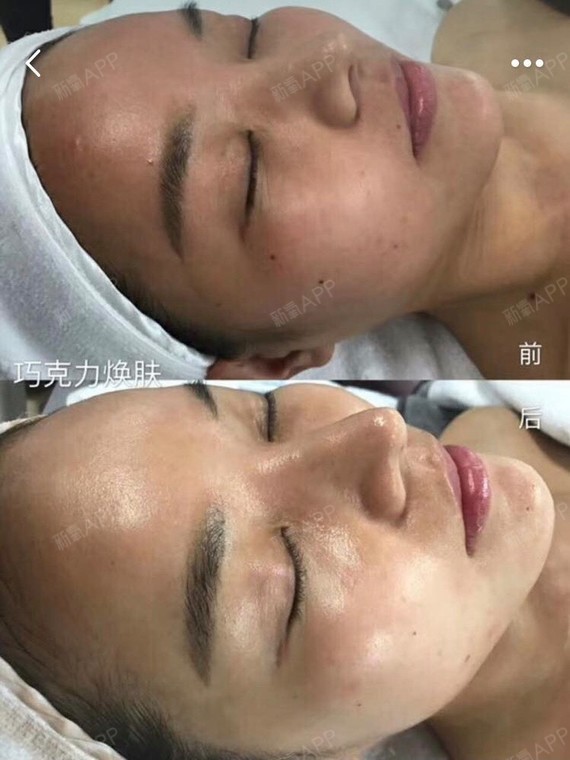 美白针好不好_效果图_krismilez美白针术后第天_新氧美容整形